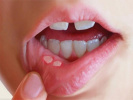 علائم احتمالی ابتلا به سرطان دهان